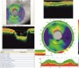 Tomografia în coerență optică în practica oftalmologică curentă