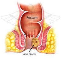 Cancerul  Anal