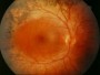 Retinita pigmentosa si tratamentul care poate minimiza rata de progresie a acestei boli poate fi efectuat in cadrul clinicii ,,Microchirurgia ochiului’’ Academ. Feodorov din Federatia Rusa