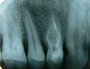 Radiografia in endodontie - cate radiografii sunt necesare, riscuri la expunere