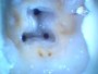 Microendodontia,  Endodontia microscopica, Endodontia sub microscop