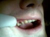 Lipsa premolarului 2. S-a optat pt o lucrare metalo-ceramicÄƒ de pe primul molar (2.6) cu extensie pe premolarul 2 (2.5)