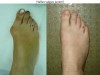 Hallux valgus sever de tip juvenil