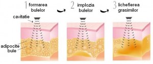 liposuctie cavitatie