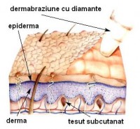 dermabraziune diamante