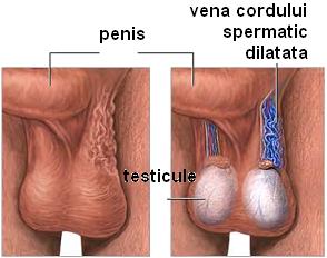 testicul varicocel