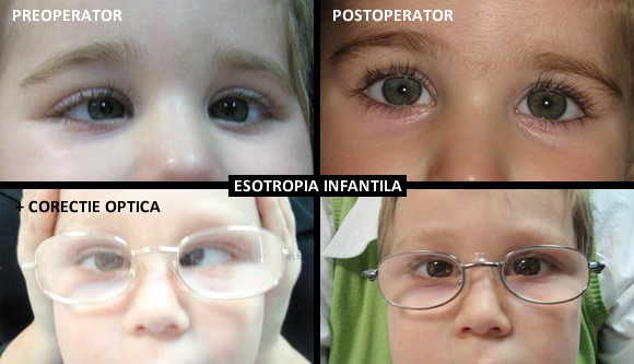 Esotropia infantila - imagini pre si postoperator