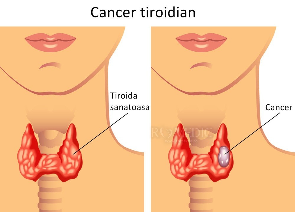 Tiroida Anatomie Si Fiziologie