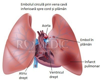 Infarctul pulmonar