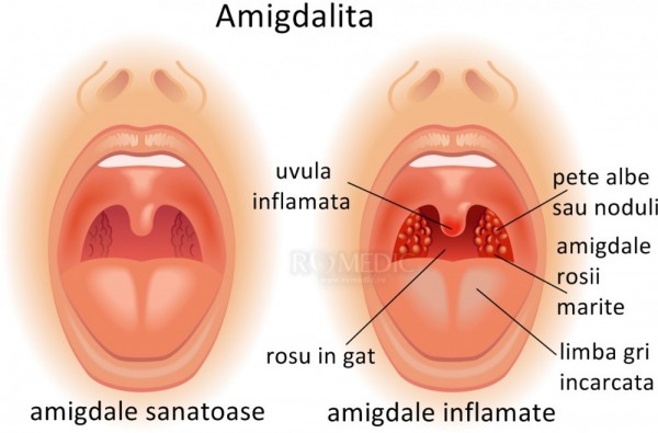 Amigdalita Angina