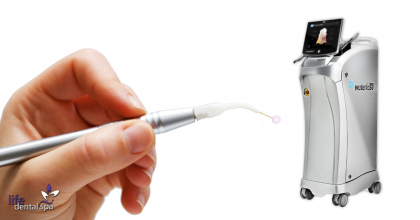 De ce sa alegi tratarea cariilor cu laserul?