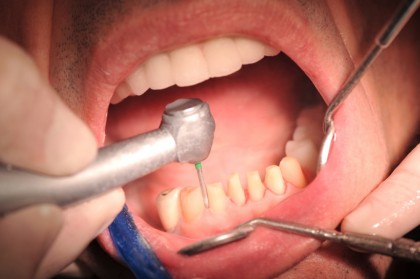 Etapele montării implantului dentar și procedura de inserare