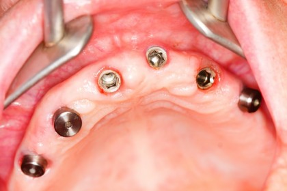 Întrebări frecvente despre implanturile dentare