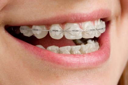 Întrebări frecvente despre tratamentul ortodontic