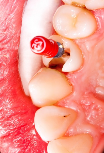 Endodonția