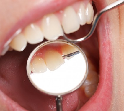 Eroziunea dinților