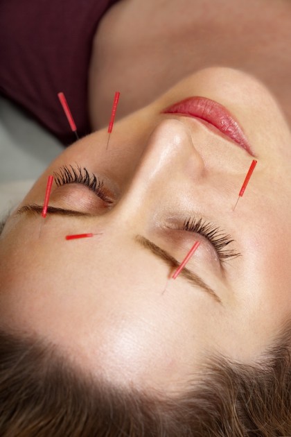 Acupunctura cosmetica - estetica