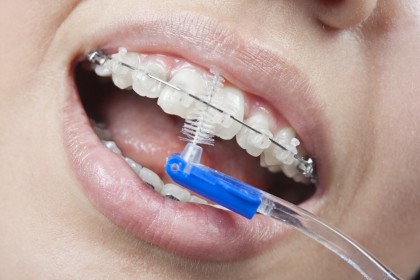 Cum îngrijesc aparatul dentar fix?