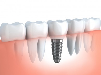 Implantul dentar - Etape înainte și după procedura chirurgicală
