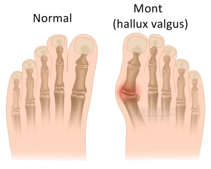 De ce apar monturile?