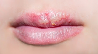 Herpesul bucal (la gură)