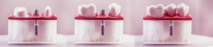 Durata de viață a implanturilor dentare
