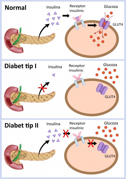 Care sunt diferențele dintre diabetul tip 1 și diabetul tip 2?
