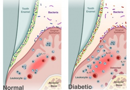 Diabetul modifică flora microbiană orală, favorizând bolile parodontale