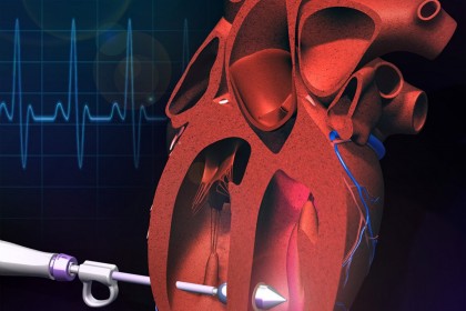 Intervențiile de chirurgie cardiacă minim invazivă – o nouă abordare