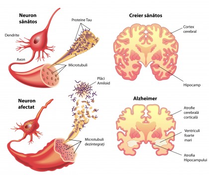 Femeile au un risc crescut de a dezvolta Alzheimer