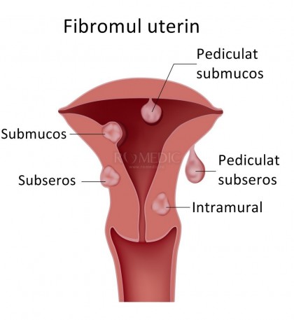 Uter fibromatos - explicații pe înțelesul tuturor