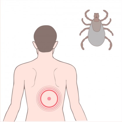 Boala Lyme, diagnosticată în doar câteva minute
