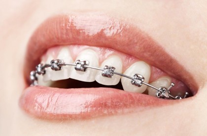Ce se întâmplă dacă nu porți aparat dentar când doctorul îl recomandă