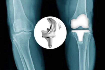 Implantul de genunchi imprimat 3D ar putea ajuta mii de bolnavi de artrită