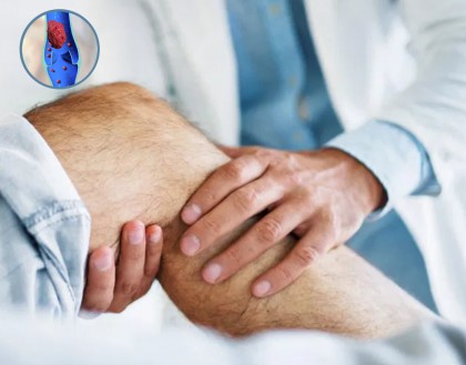 Tehnica imagistică ar putea deveni tratament pentru tromboza venoasă profundă