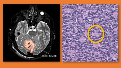 Meduloblastomul, un cancer grav al sistemului nervos, oprit cu ajutorul unei combinații a două terapii vechi