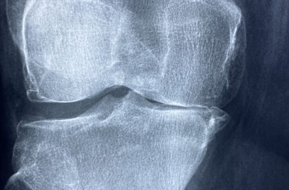 Un antioxidant regăsit în nuci ar putea ajuta pacienții cu osteoartrită