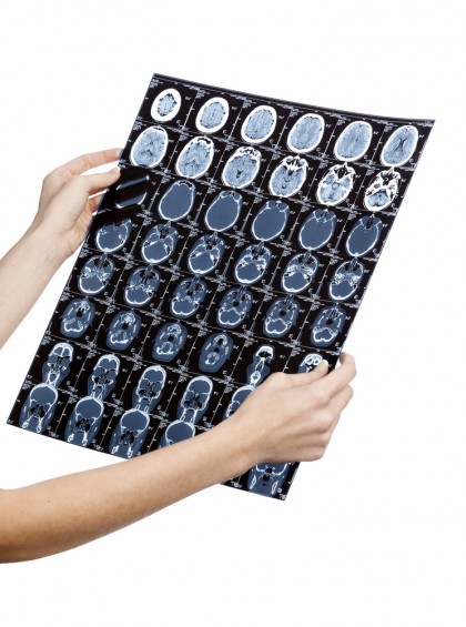 Diagnosticul glioblastomulului, o formă agresivă de cancer, ar putea fi realizat cu ajutorul unei biopsii