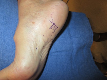 Pacienții cu fasciită plantară ar putea beneficia de un tratament eficient și sigur