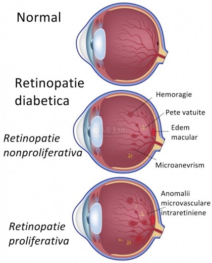 Lentile de contact cu LED-uri inteligente care pot preveni sau trata retinopatia diabetică