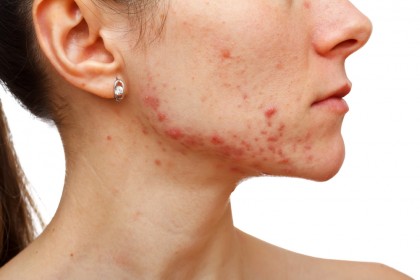 Tratamentul corect al acneei - se storc coșurile sau nu?