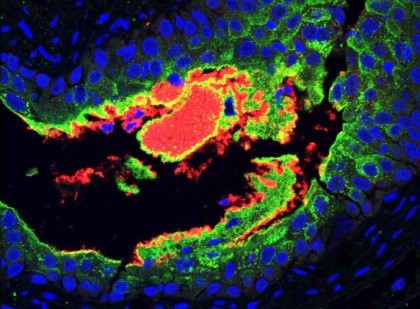Infecțiile tractului urinar și diabetul: care este legătura dintre cele două patologii?