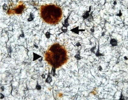 Genele săltărețe și procesul inflamator din Alzheimer