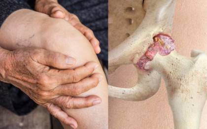 Rolul proteinei Klotho în osteoartrită