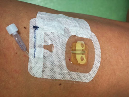 Perfuzia subcutanată (hipodermocliza)