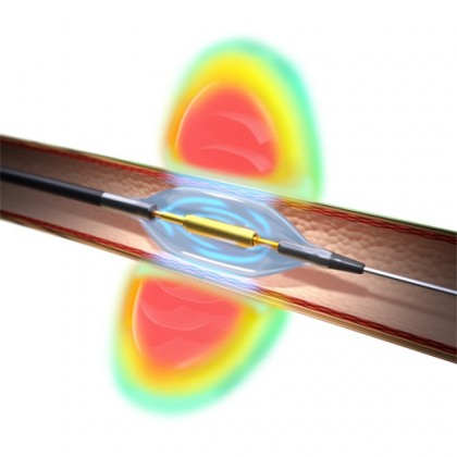 Un dispozitiv cu ultrasunete ar putea deveni noul tratament pentru hipertensiune