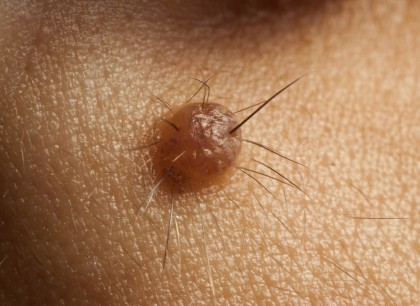 Aluniță cu păr - riscuri, tratament, recomandări