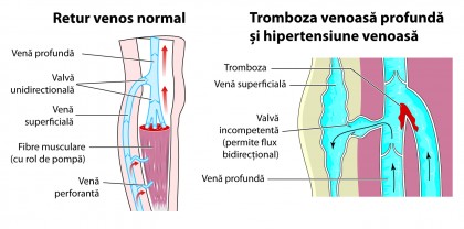 Tromboflebita piciorului