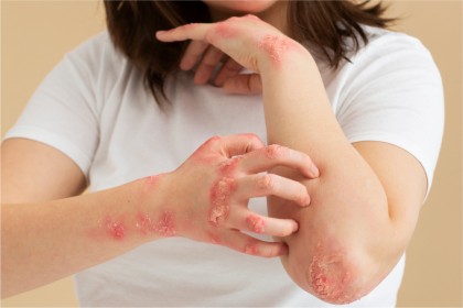 Tratamentul psoriazisului cu secukinumab (anticorp monoclonal anti-interleukina-17A)