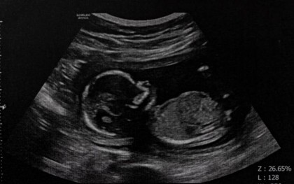 Noi metode de predicție a deznodământului sarcinilor cu probleme de creștere intrauterină